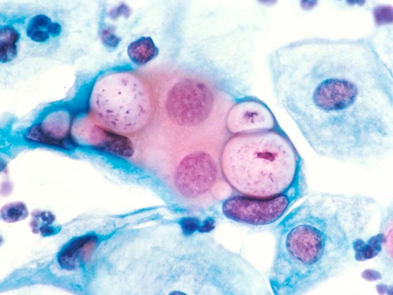 3 sexually transmitted diseases hit new highs again in US